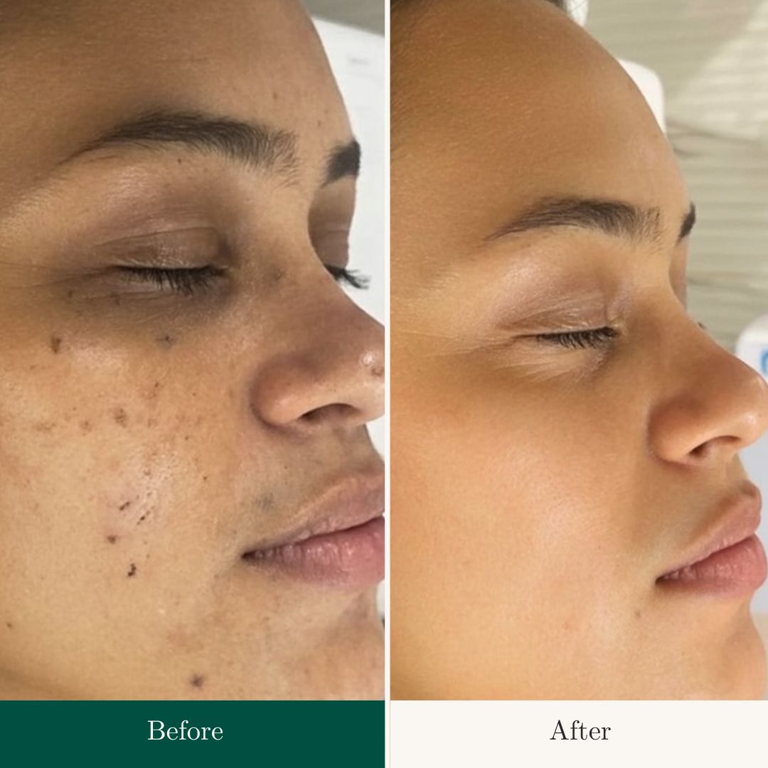 Before After 2